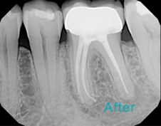 Root Canal Brentwood - Endodontics